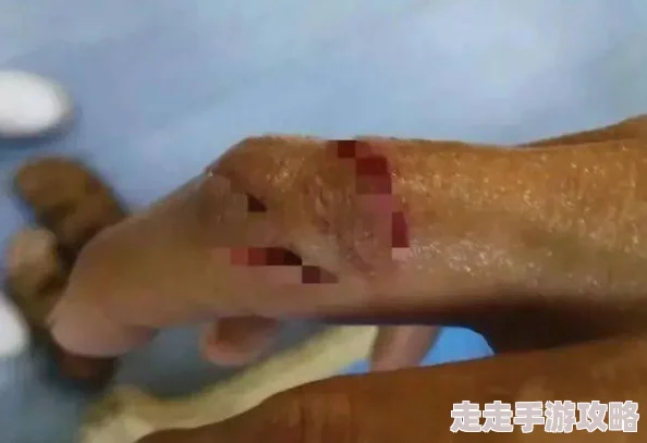 女子被40厘米黑鱼咬伤送医