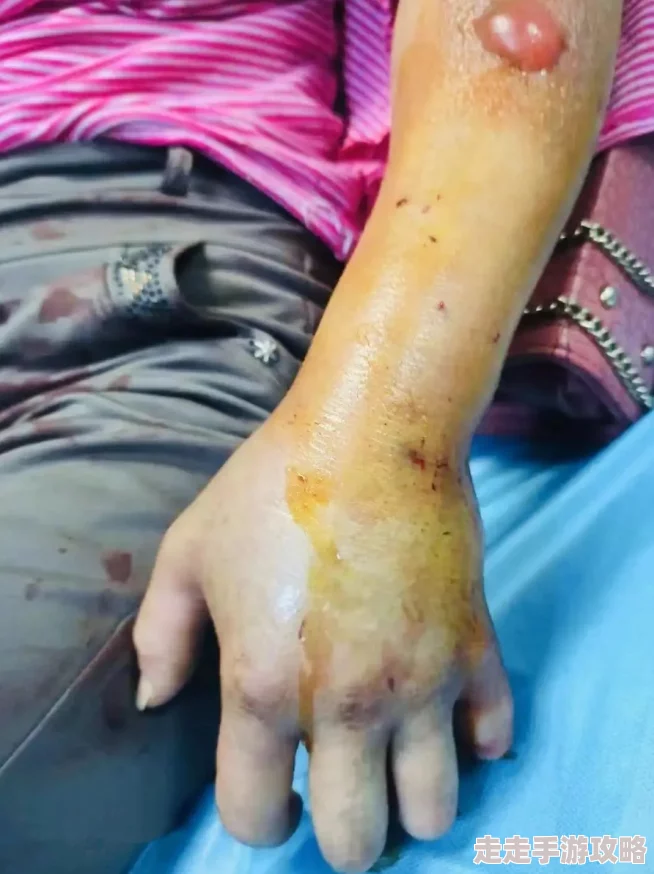 女子被40厘米黑鱼咬伤送医