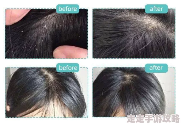 男朋友总爱吃我头头怎么办 头皮屑困扰?试试这些洗发水或咨询医生 男朋友总爱吃我头头怎么办 头皮屑困扰?试试这些洗发水或咨询医生