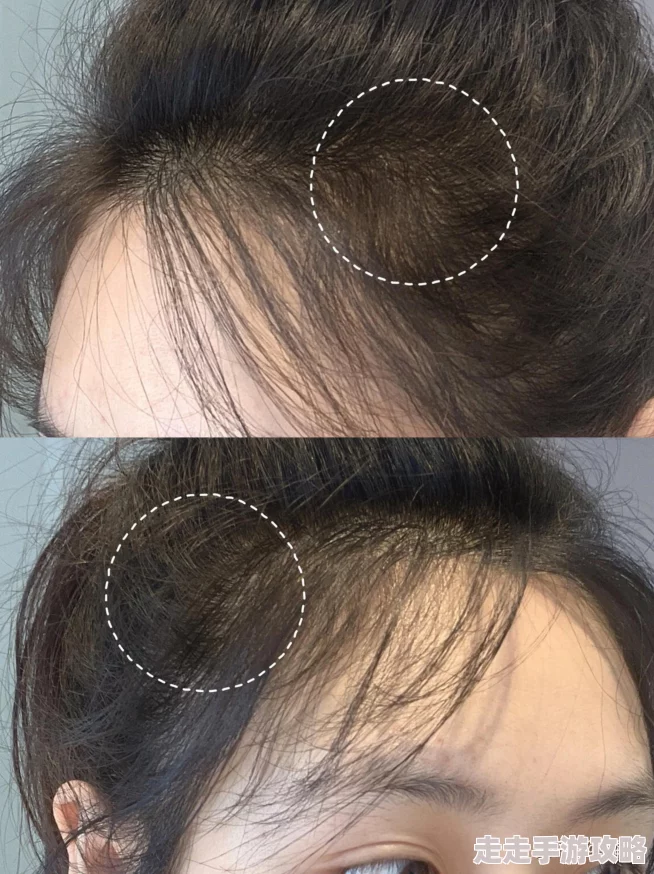 男朋友总爱吃我头头怎么办 头皮屑困扰?试试这些洗发水或咨询医生 男朋友总爱吃我头头怎么办 头皮屑困扰?试试这些洗发水或咨询医生